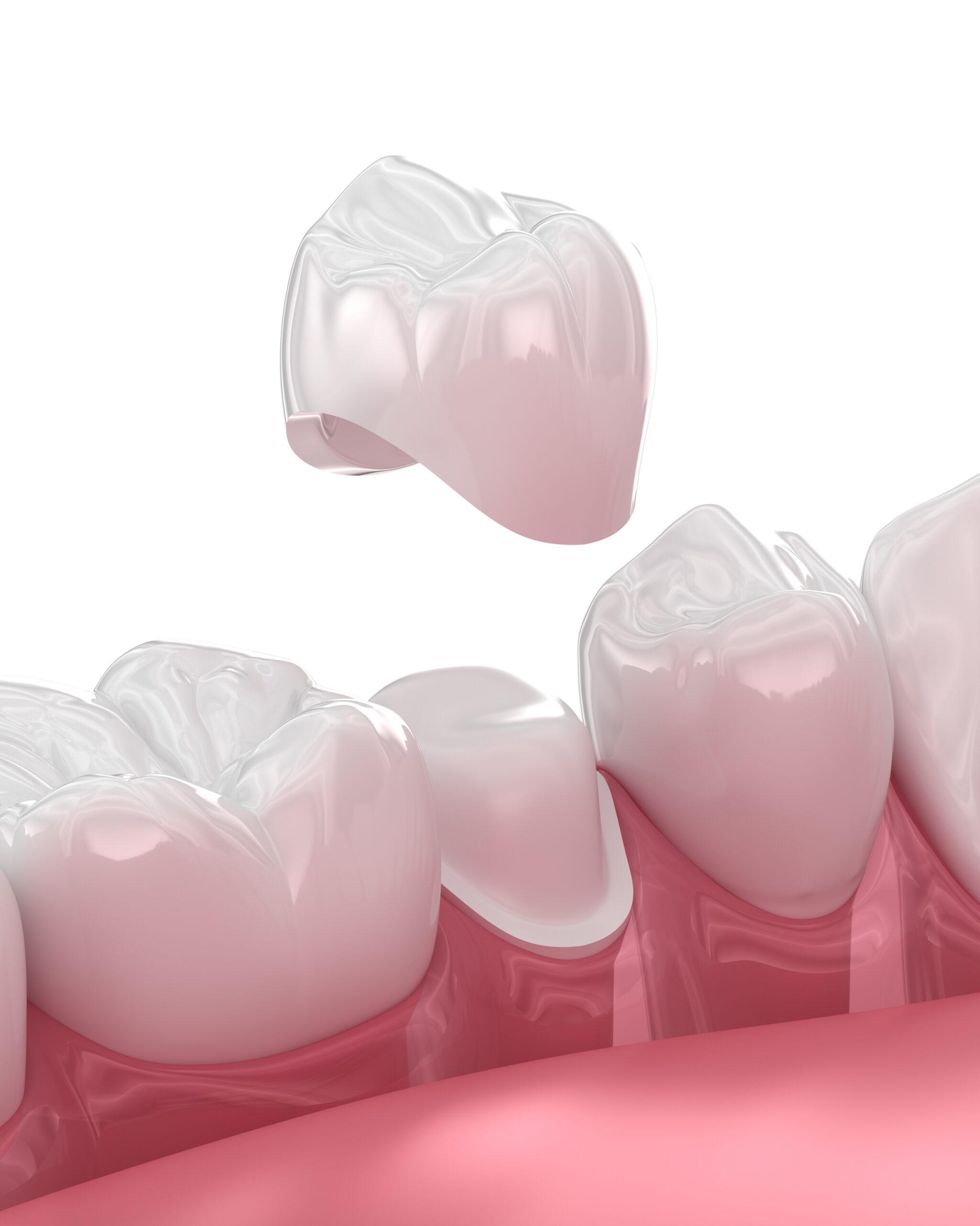 Dental crown placement over tooth. 3D illustration