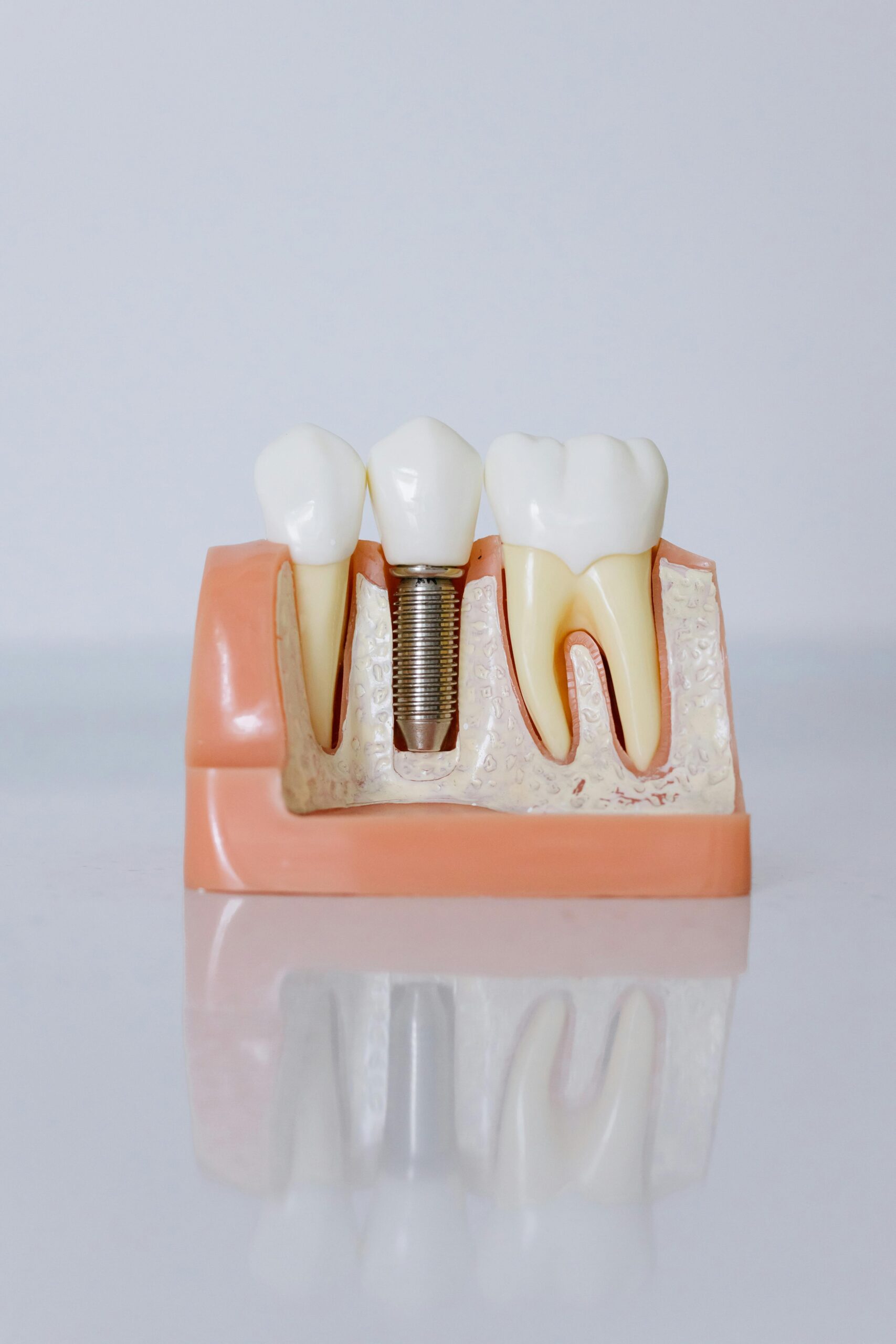 Close-Up Shot of Dental Implant Model (3)